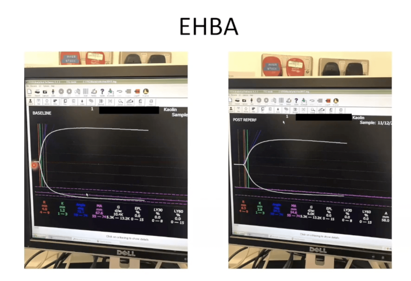 Liver Transplant Anaesthesia – Dr Anish Gupte