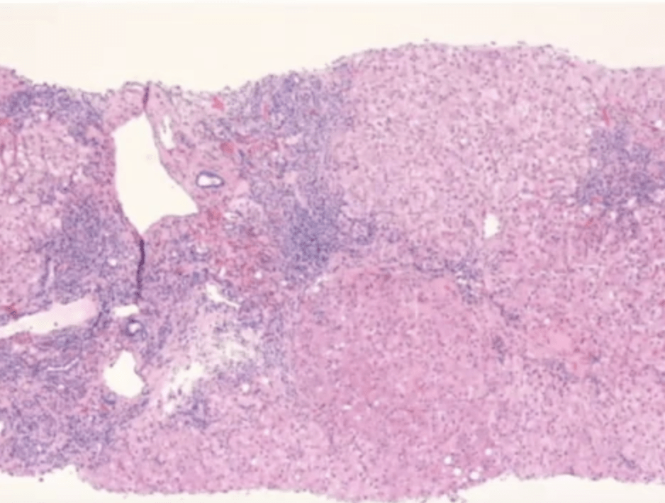 King’s College Teaching – Autoimmune Liver Disease – Dr Marianne Samyn