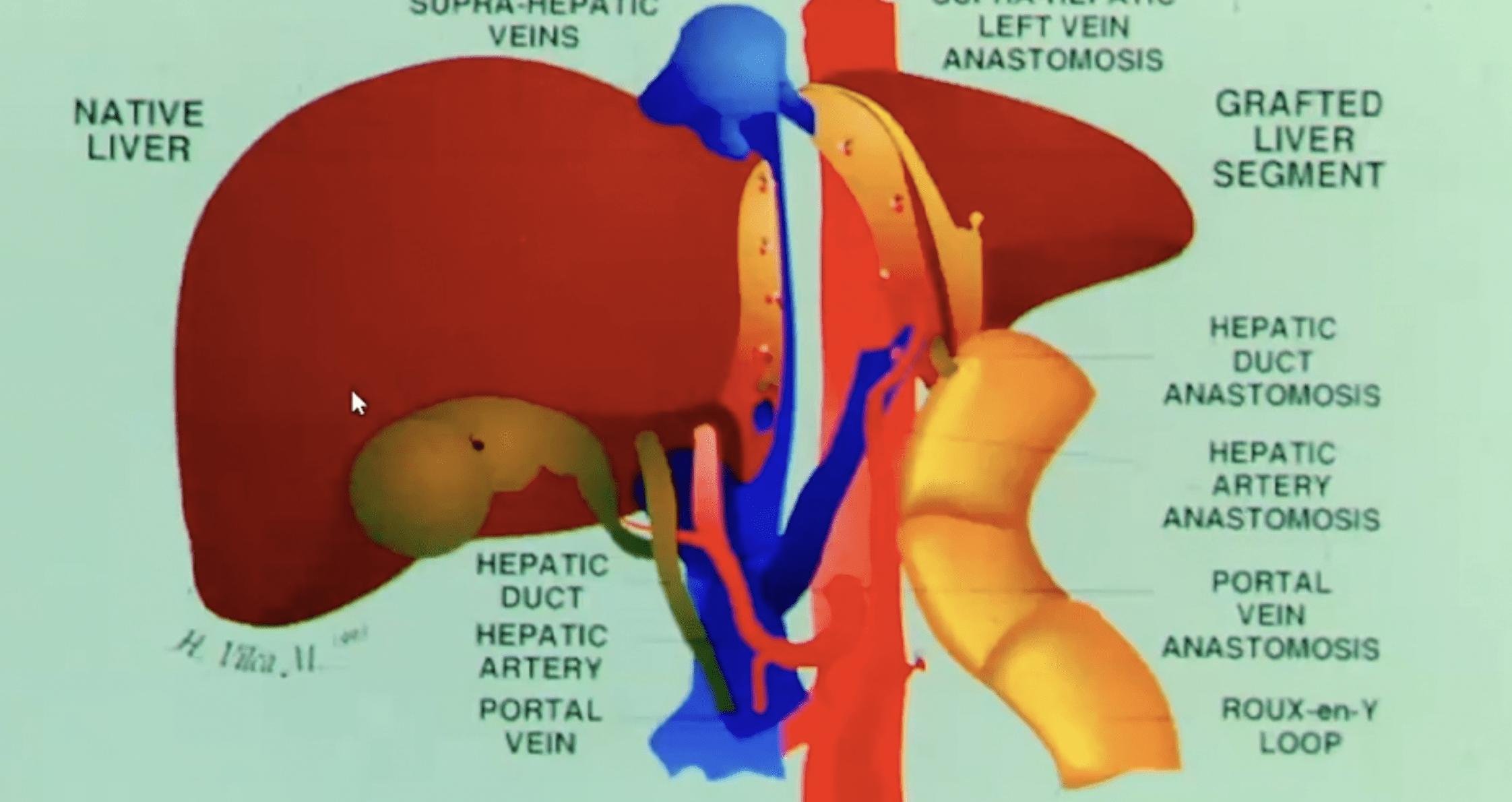 Acute Liver Failure and Hepatocyte Transplantation – Prof. Anil Dhawan